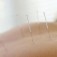 acupunctuur